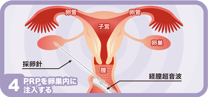 4.PRPを卵巣内に注入する